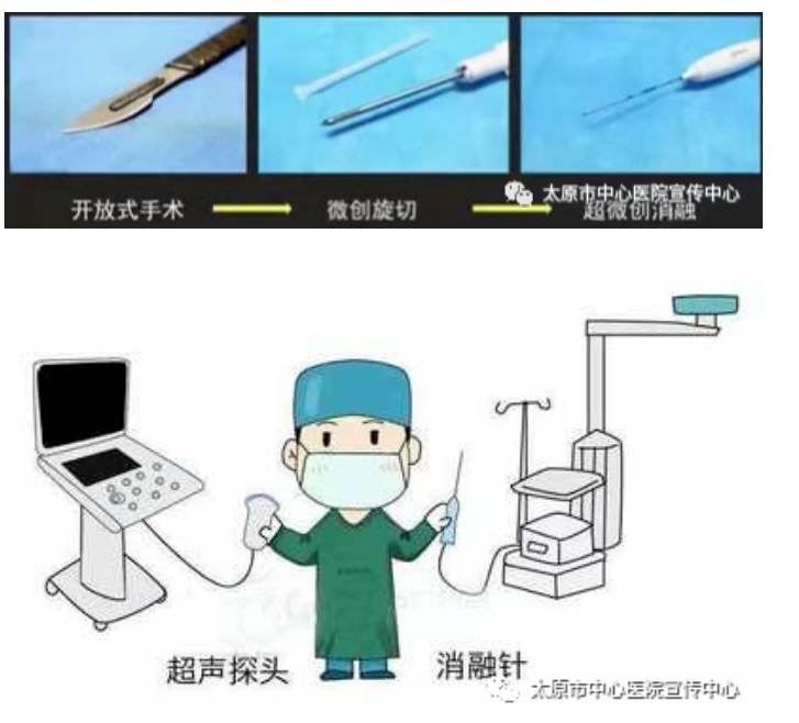 微波怎么治疗百项技术 ｜ 不开刀、不留痕——乳腺肿物微波消融术“一针”搞定 轻松“秒杀”肿瘤_https://www.jmylbn.com_新闻资讯_第4张